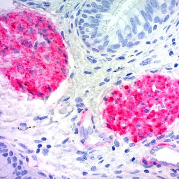 Melanoma Associated Antigen; Clone KBA.62 (Ready-To-Use)